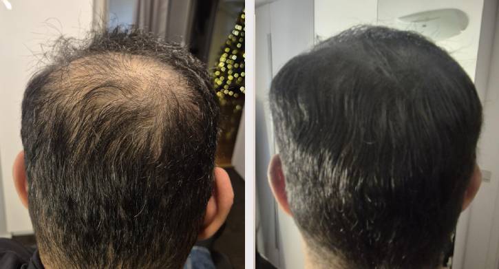 SMP Scalp Micro Pigmentation