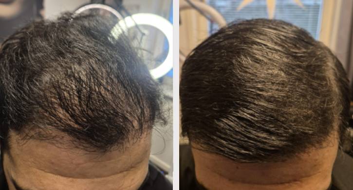 SMP Hårtätning övre del av huvud