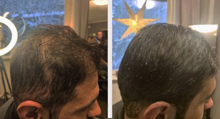 SMP Hårtätning övre/bakre/sida del av huvud